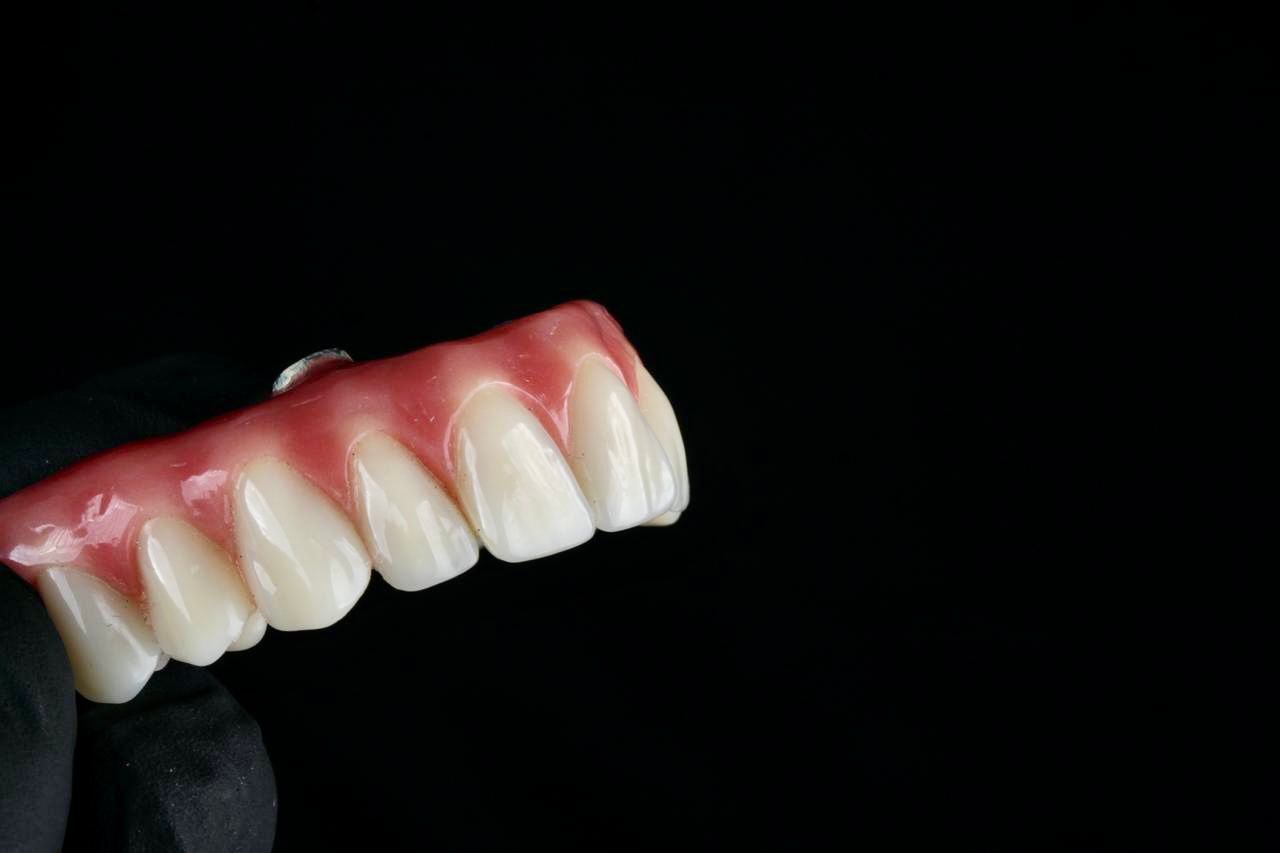 Detalhe anterior — caso real prótese protocolo Sallut Odontologia Valinhos